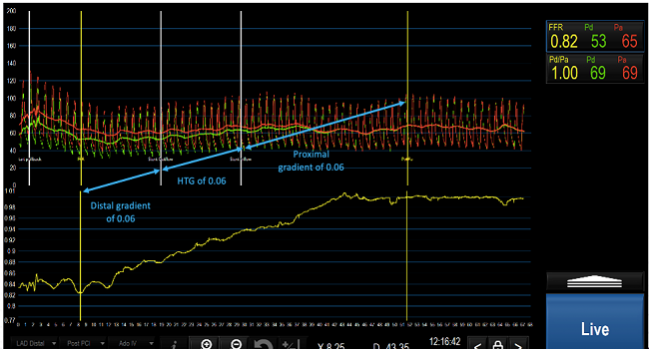 FFR Insights Before and After PCI: Fresh Food for Thought